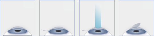 Lasik-Diagram-NoCaptions