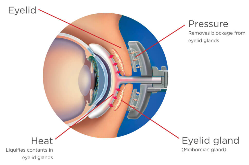 Diagram of the Lipiflow machine on the eye showing the pressure points, heat points and eyelid gland location